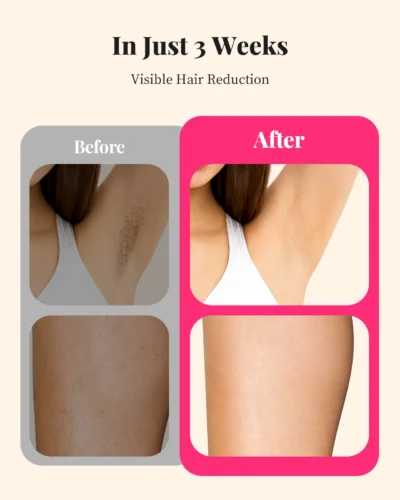 IPL Hair Removal Device – 990,000 Flashes, Painless Permanent for Face & Body - Image 6